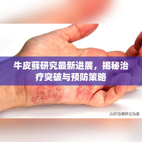 牛皮藓研究最新进展，揭秘治疗突破与预防策略
