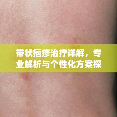 带状疱疹治疗详解，专业解析与个性化方案探索